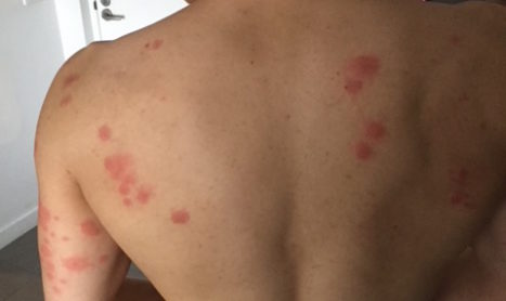 Bedbug Bites Melbourne
